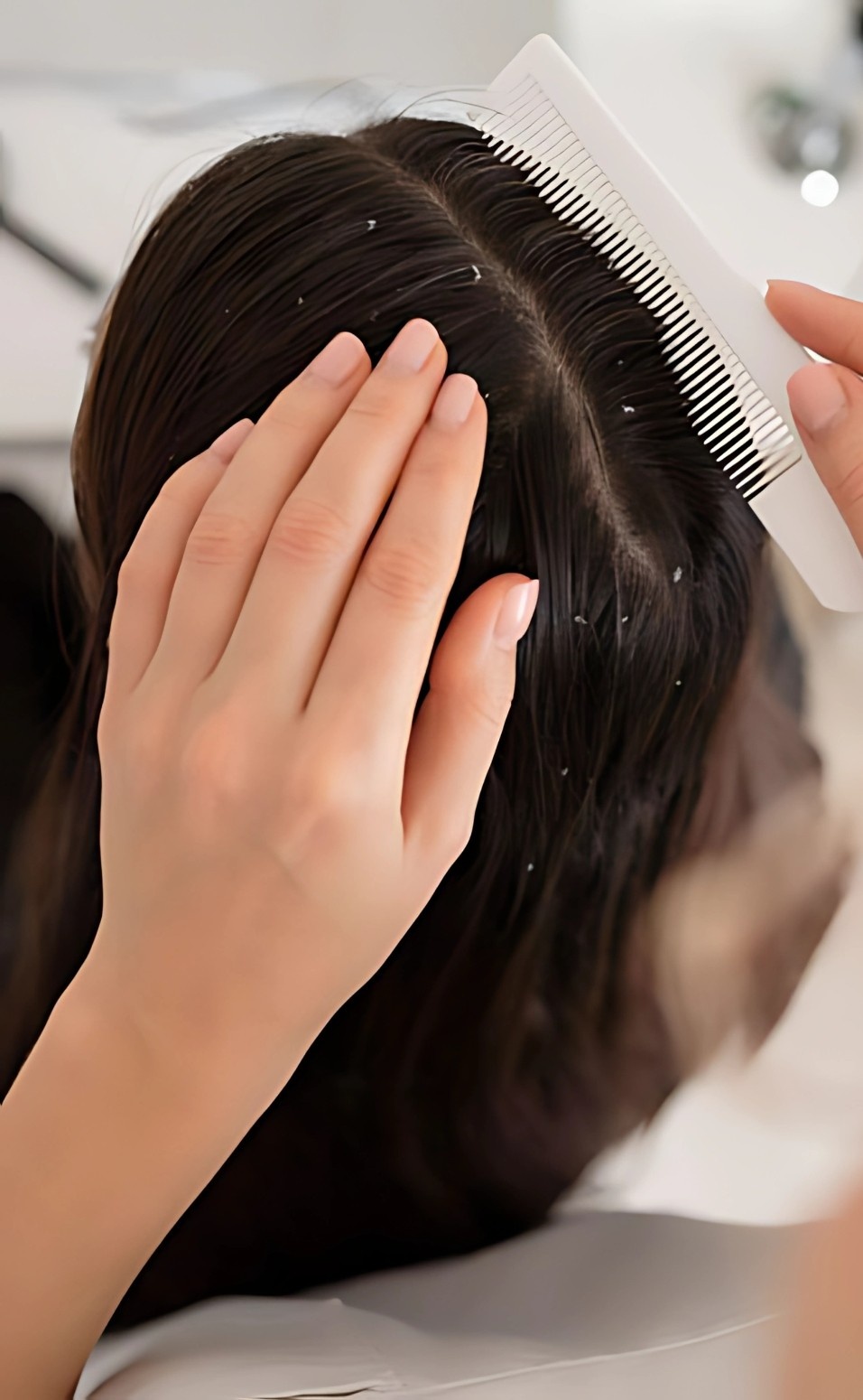 Dandruff Treatment
